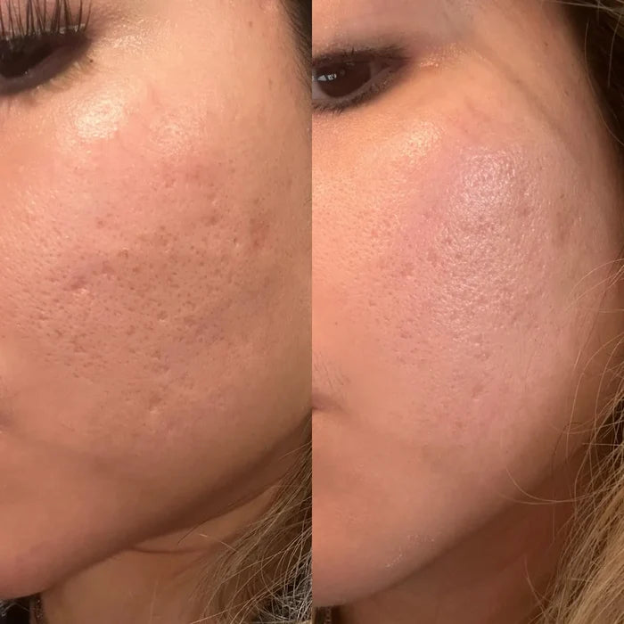 Exquisite Laser Clinic treatment Microneedling Treatment Full Face